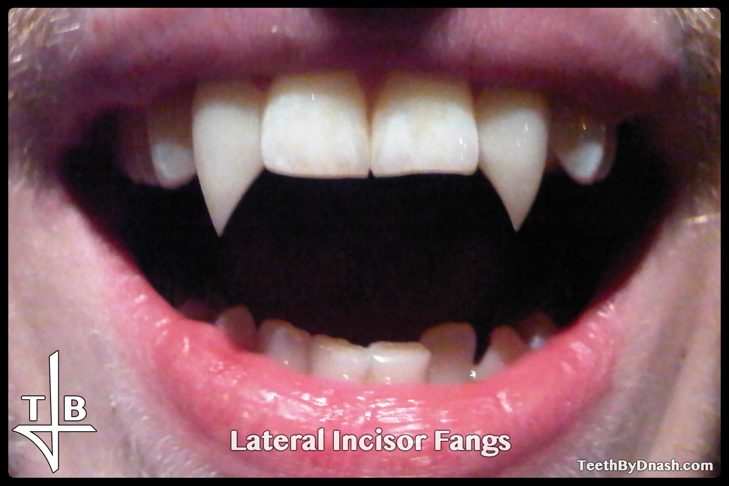 http://lateral_incisor-custom_fangs-teeth_by_dnash-02