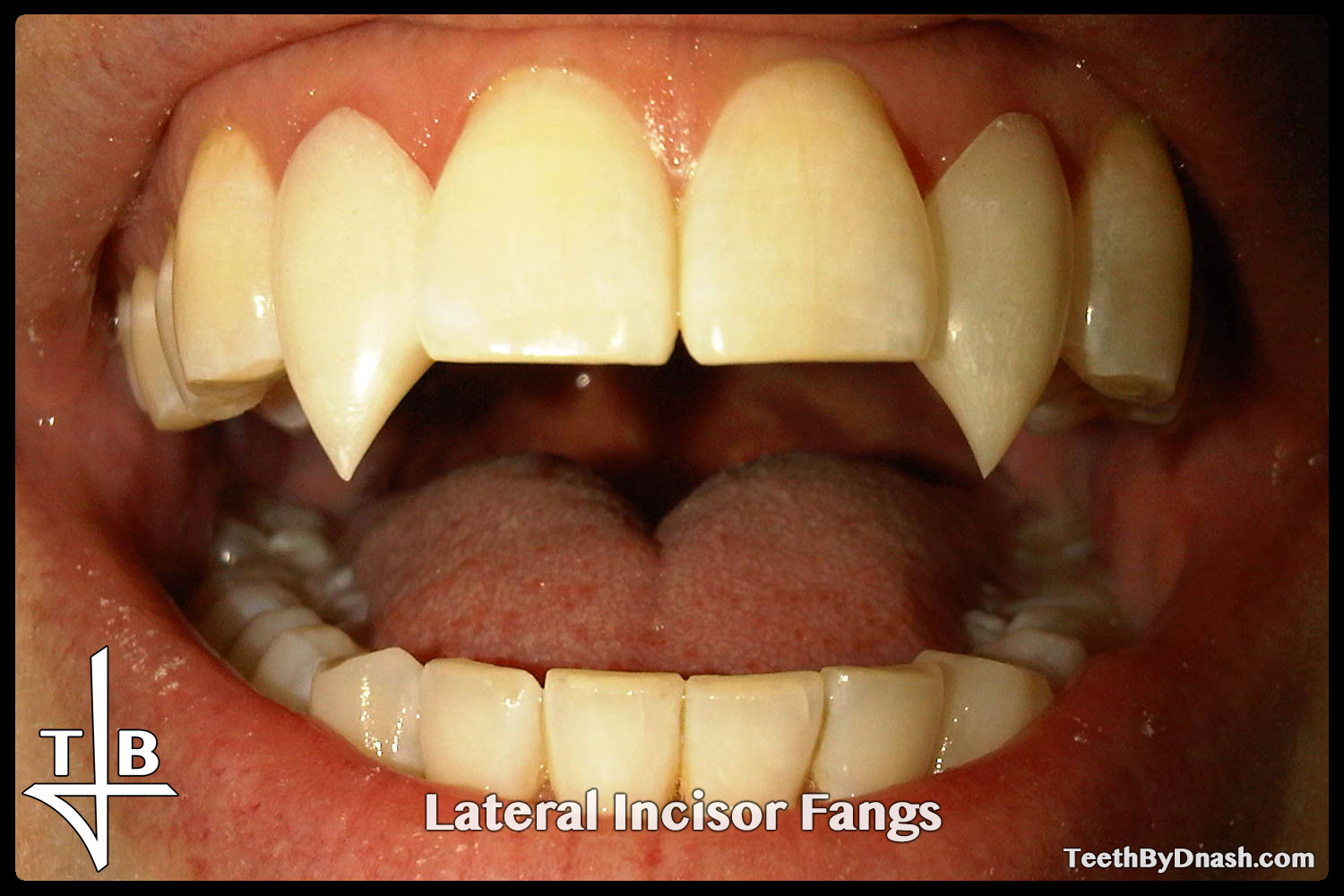 http://lateral_incisor-custom_fangs-teeth_by_dnash-03