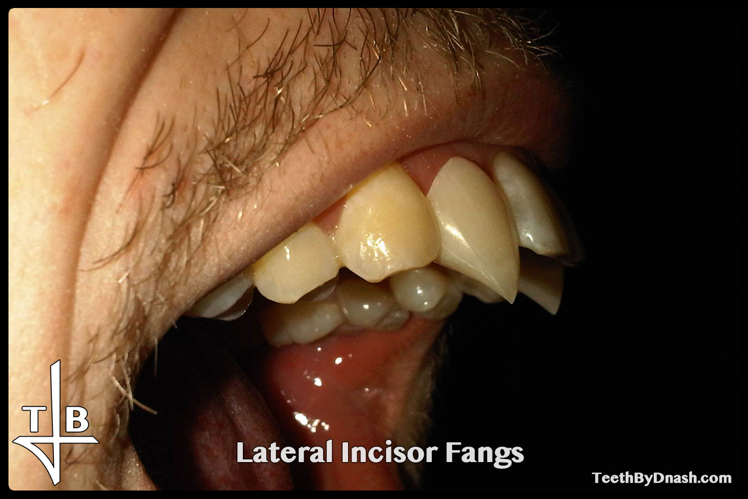 http://lateral_incisor-custom_fangs-teeth_by_dnash-04