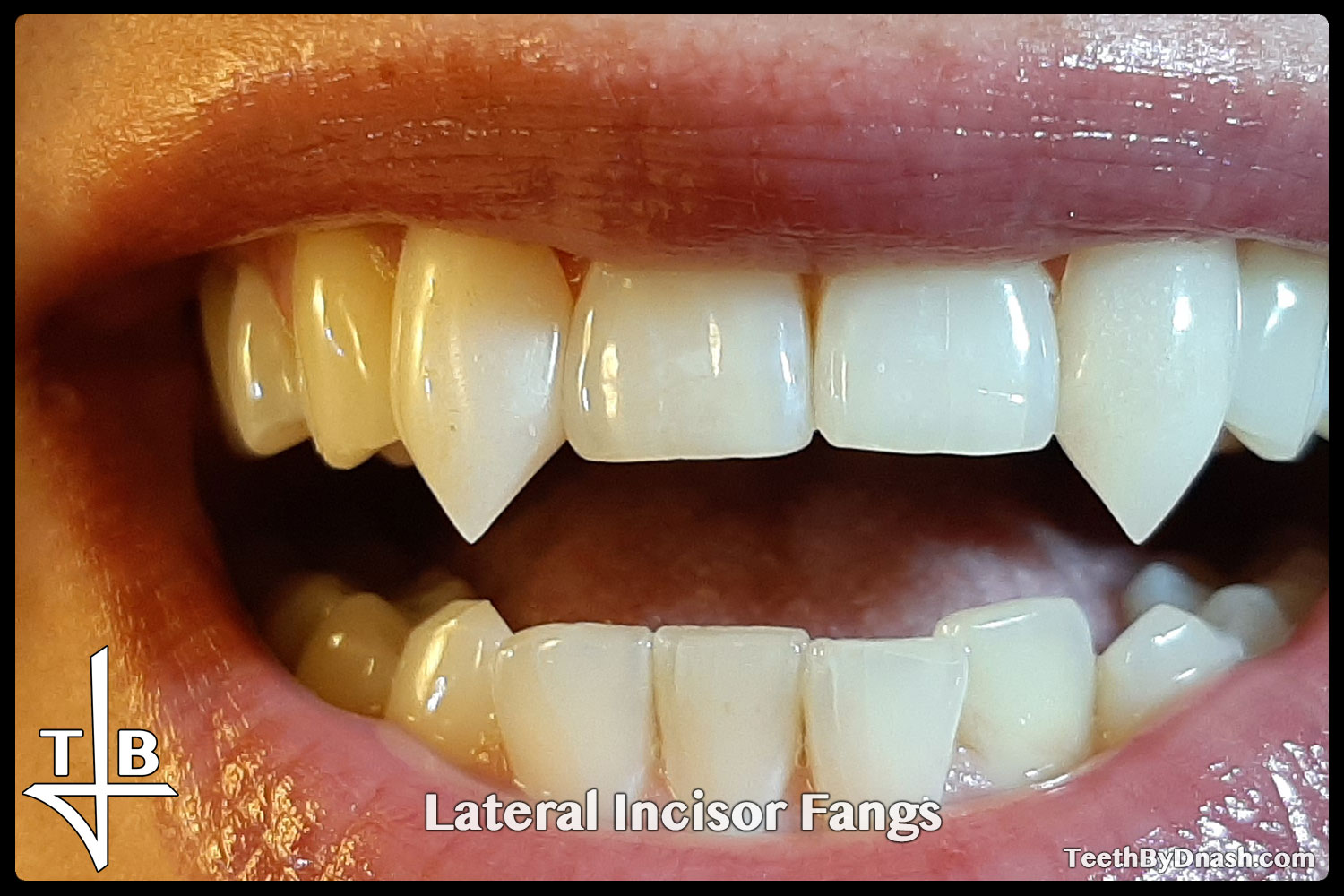 http://lateral_incisor-custom_fangs-teeth_by_dnash-06
