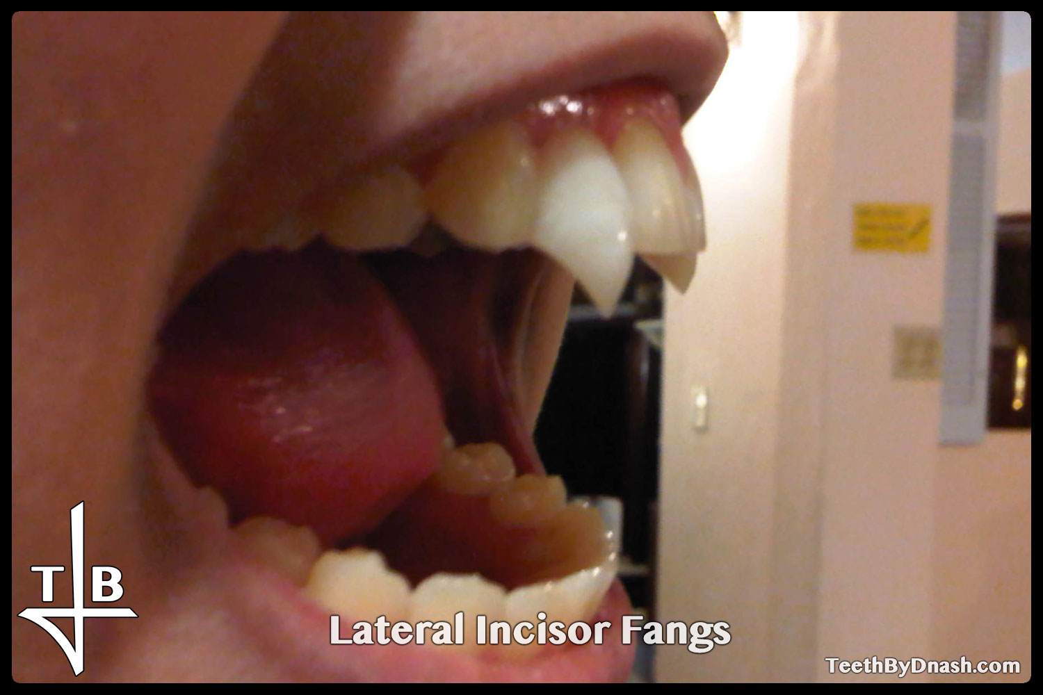 http://lateral_incisor-custom_fangs-teeth_by_dnash-09