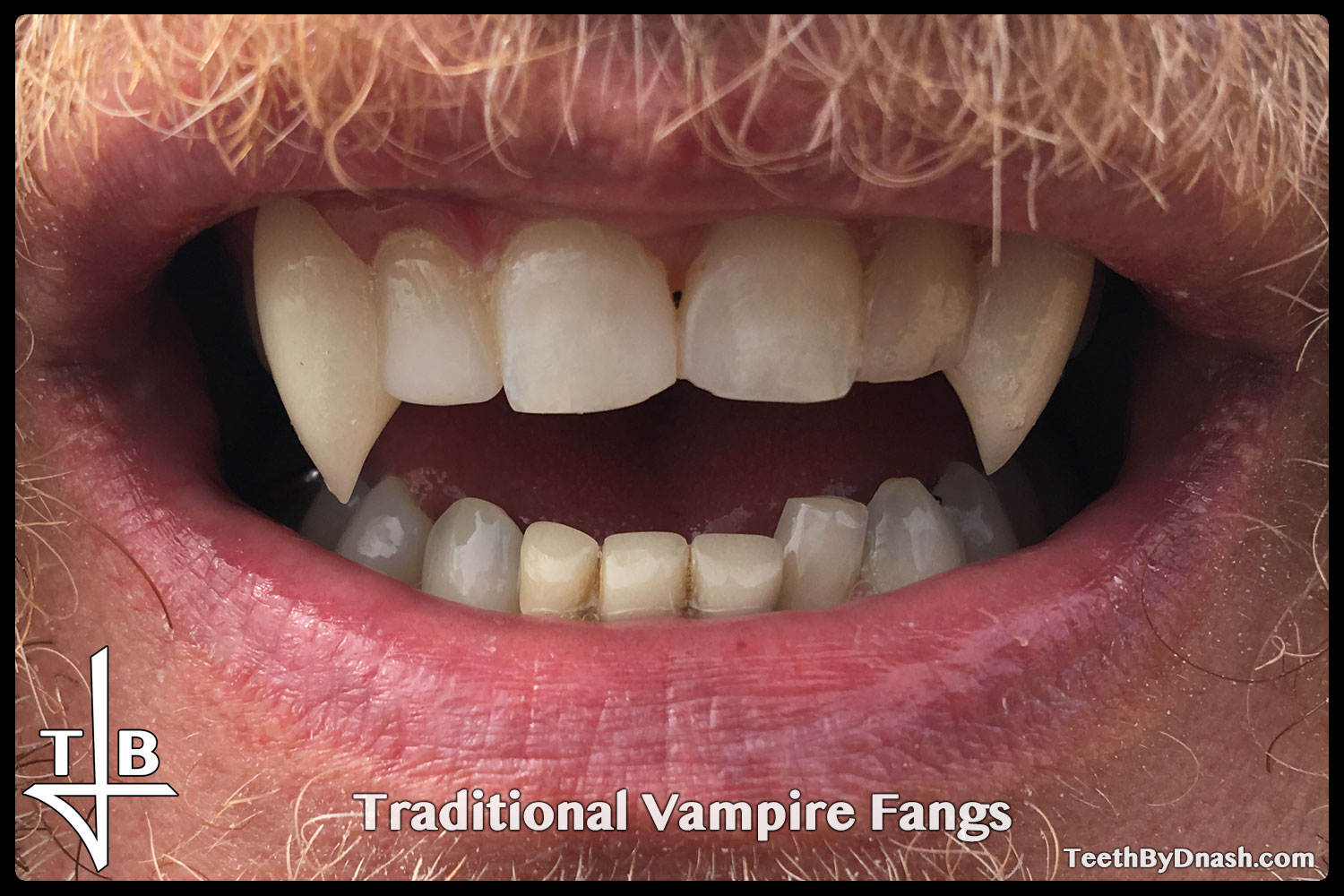 http://traditional_vampire-custom_fangs-teeth_by_dnash-13